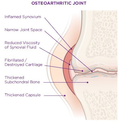 oa affected joint